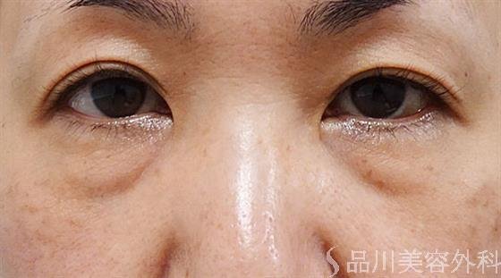 症例NO.56108のBEFORE写真