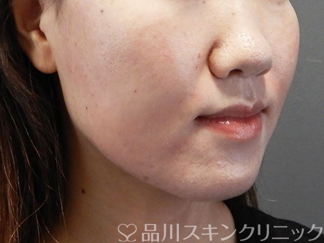 症例NO.71600のAFTER写真