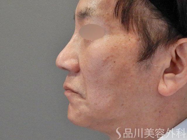 症例NO.74770のAFTER写真