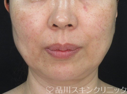症例NO.70955のBEFORE写真