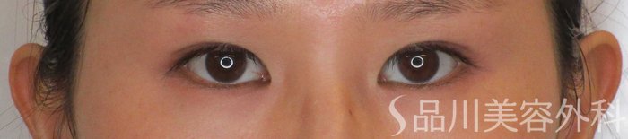 症例NO.64964のBEFORE写真