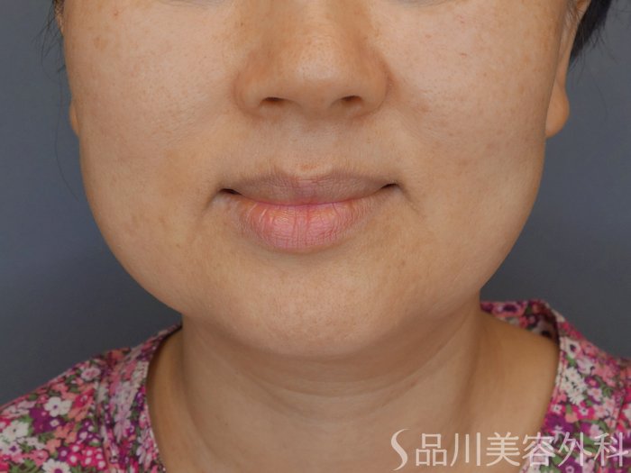 症例NO.71657のBEFORE写真