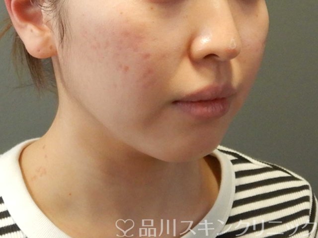 症例NO.66628のBEFORE写真