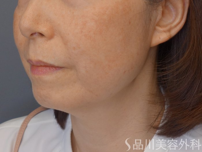 症例NO.72140のBEFORE写真