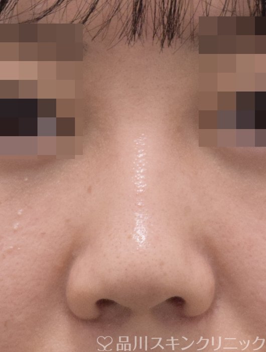 症例NO.71736のAFTER写真