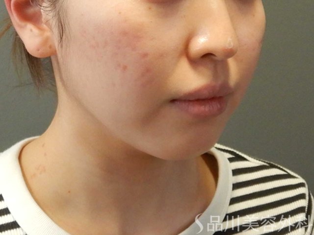 症例NO.66628のBEFORE写真