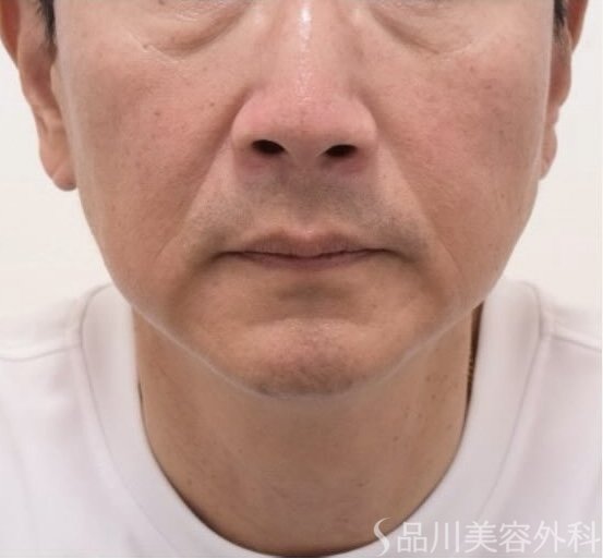 症例NO.71666のBEFORE写真