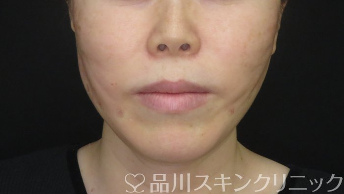 症例NO.72908のAFTER写真