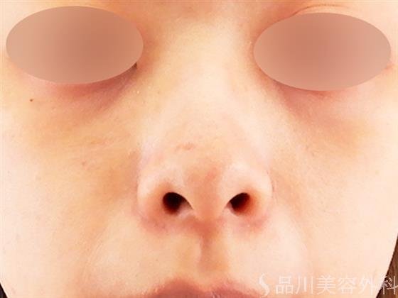 症例NO.60673のAFTER写真