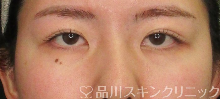 症例NO.69755のBEFORE写真