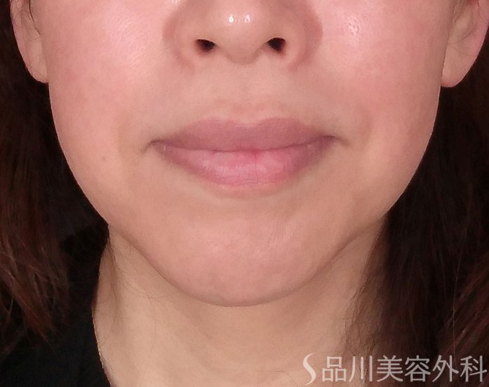 症例NO.70320のBEFORE写真