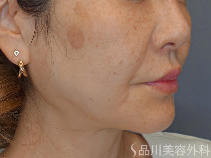 症例NO.73995のBEFORE写真