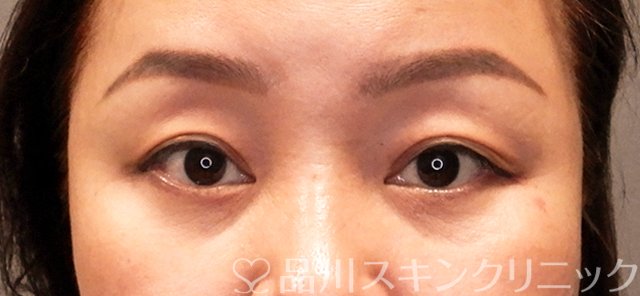症例NO.71137のBEFORE写真