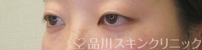 症例NO.74203のBEFORE写真