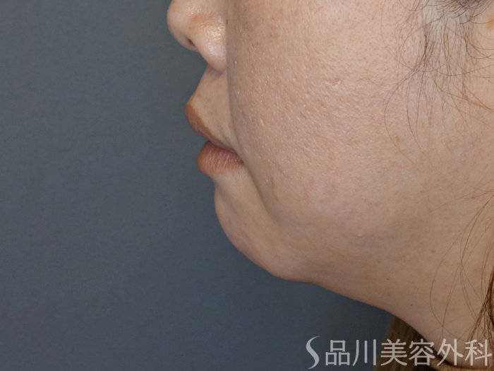 症例NO.70434のBEFORE写真