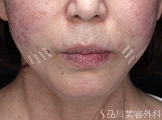 症例NO.71053のAFTER写真