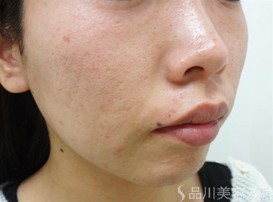 症例NO.31582のAFTER写真