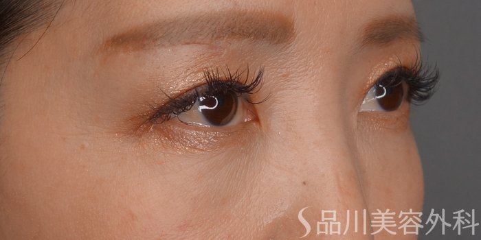 症例NO.73235のAFTER写真