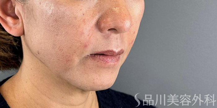 症例NO.72475のAFTER写真