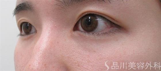症例NO.35855のBEFORE写真