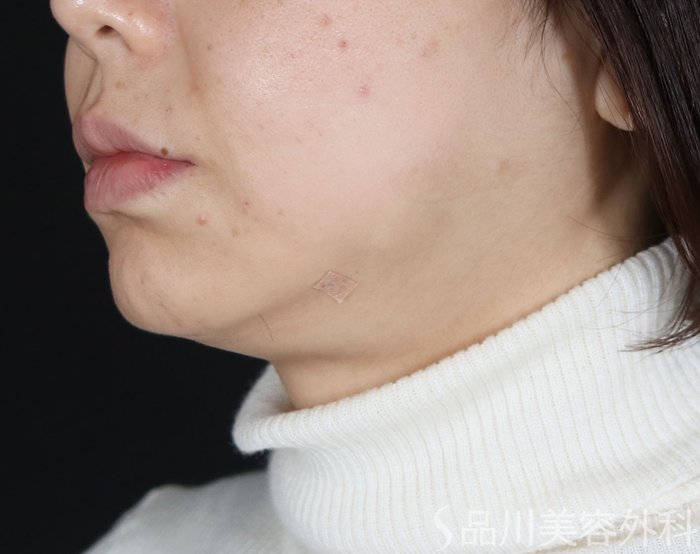 症例NO.73485のAFTER写真