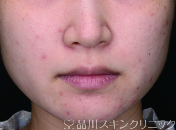 症例NO.74174のBEFORE写真
