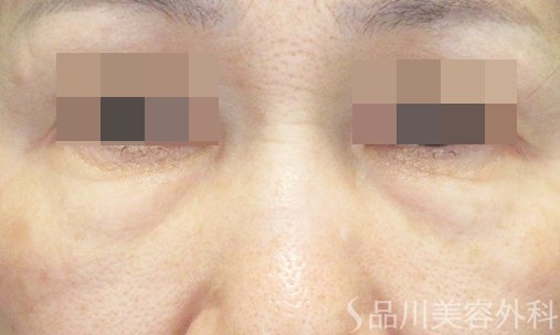 症例NO.68923のBEFORE写真