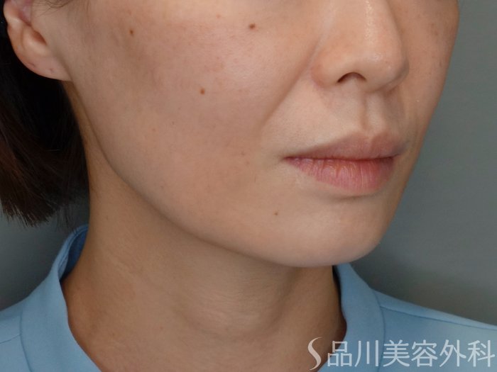 症例NO.69471のBEFORE写真