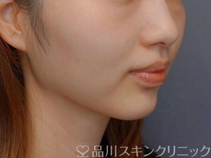 症例NO.74192のBEFORE写真