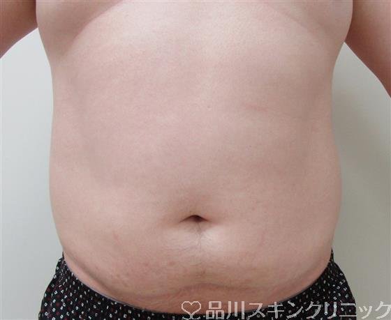 症例NO.32799のBEFORE写真
