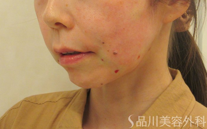 症例NO.71711のAFTER写真