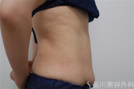 症例NO.21021のAFTER写真
