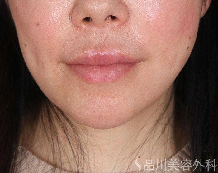 症例NO.73346のAFTER写真