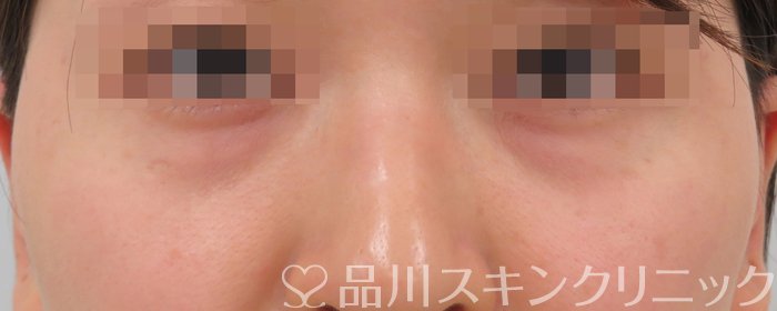 症例NO.63023のBEFORE写真