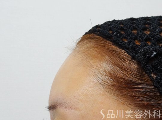 症例NO.69637のBEFORE写真