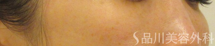 症例NO.72100のAFTER写真