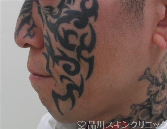 症例NO.26721のBEFORE写真
