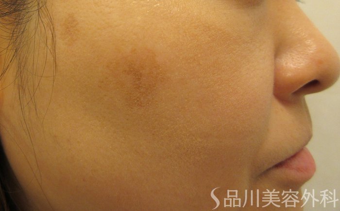 症例NO.72612のAFTER写真