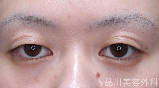 症例NO.74876のBEFORE写真