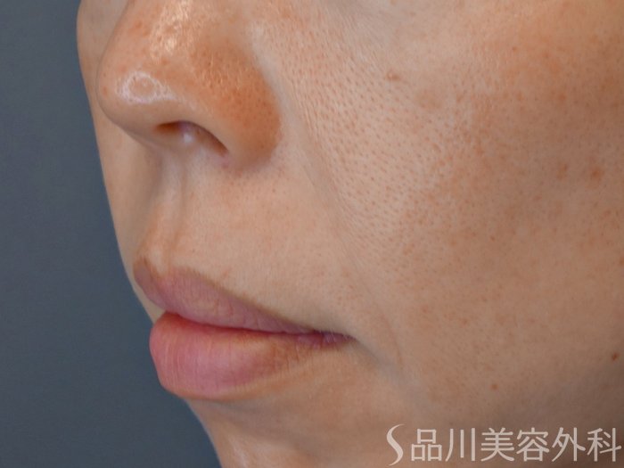 症例NO.67943のBEFORE写真