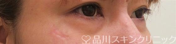 症例NO.56200のBEFORE写真