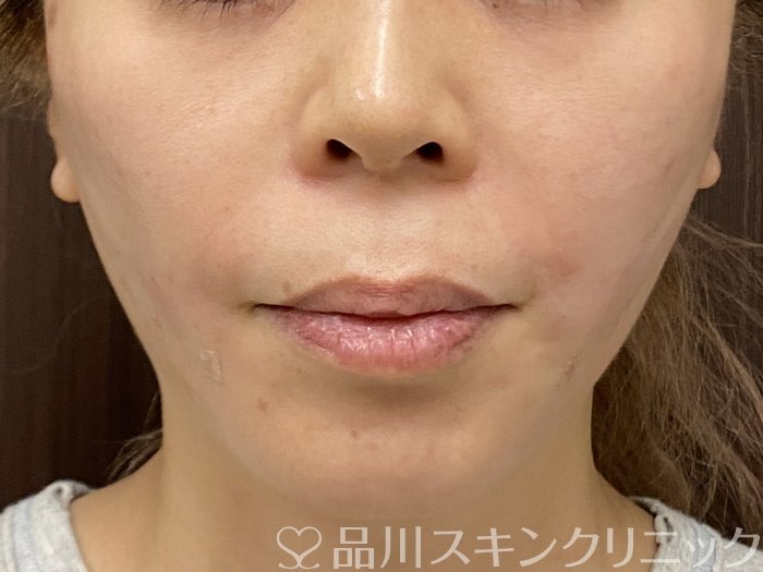 症例NO.73957のAFTER写真