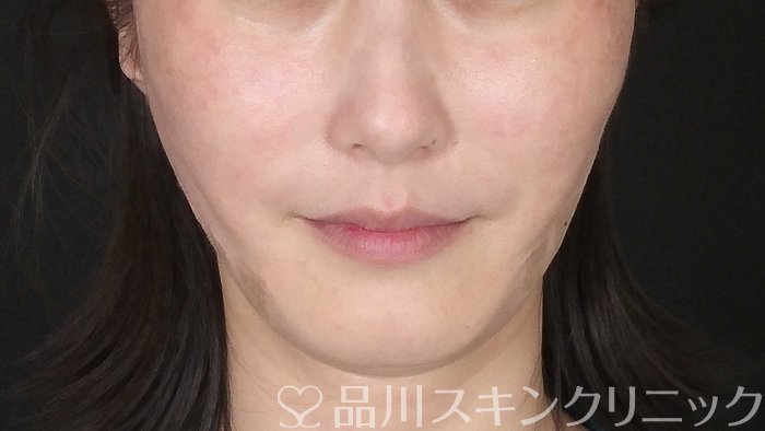 症例NO.72681のAFTER写真