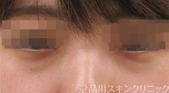 症例NO.49824のBEFORE写真