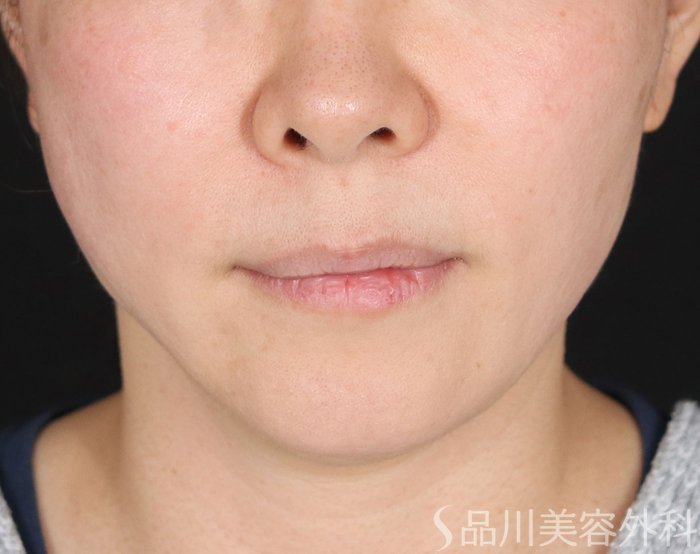 症例NO.72402のAFTER写真