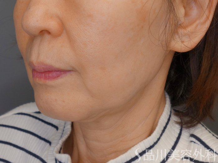 症例NO.70279のBEFORE写真