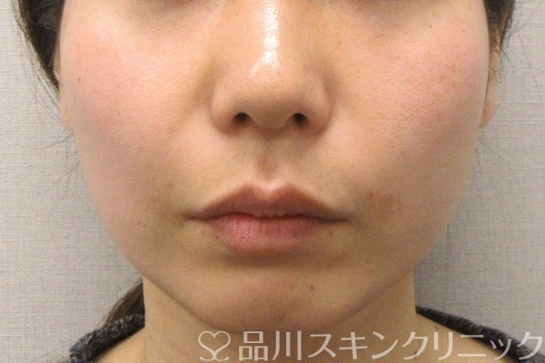 症例NO.69277のAFTER写真