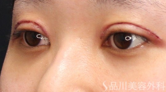 症例NO.70006のAFTER写真