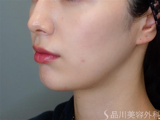 症例NO.50832のBEFORE写真
