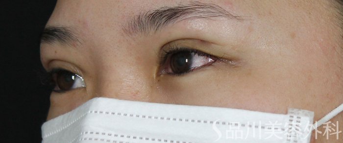 症例NO.72777のAFTER写真